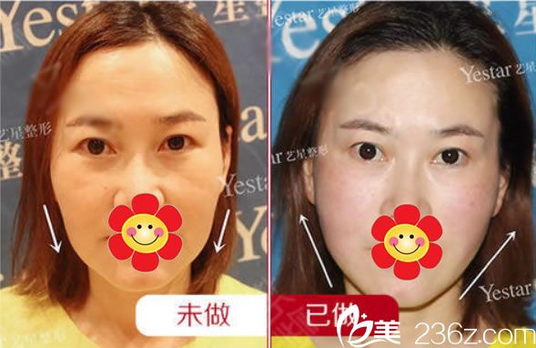 臺(tái)州藝星祁薇面部抗衰真實(shí)案例 臺(tái)州藝星祁薇面部抗衰真實(shí)案例