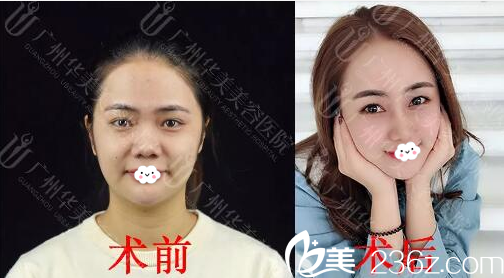 廣州華美<!--<i data=20240703-sp></i>-->鼻綜合隆鼻案例