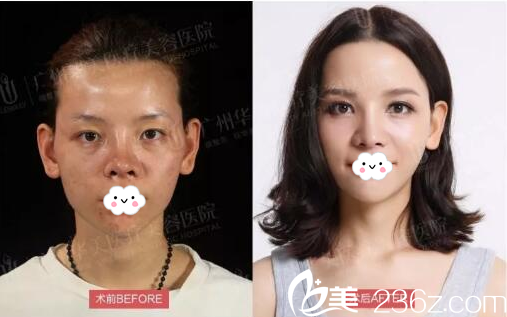 廣州華美<!--<i data=20240703-sp></i>-->隆鼻失敗修復(fù)案例效果圖