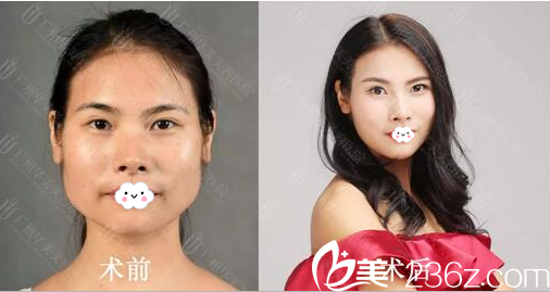 廣州華美<!--<i data=20240703-sp></i>-->做的面部自體脂肪填充案例