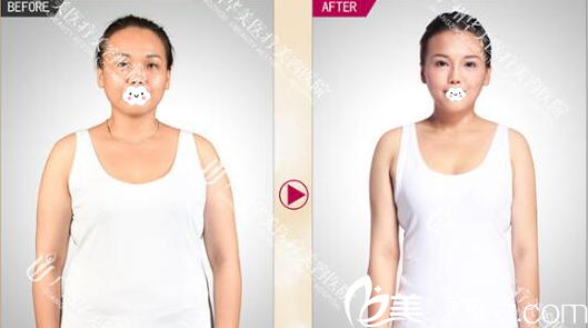 廣州華美整形醫(yī)院<!--<i data=20240703-sp></i>-->吸脂案例