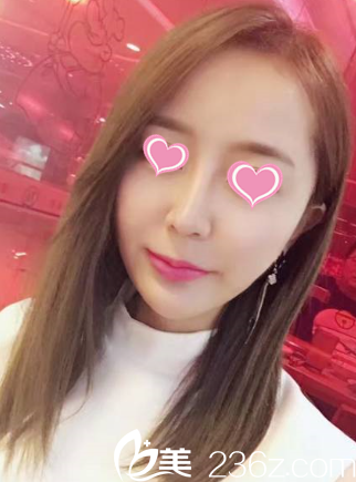 我這不做了假體隆鼻+耳軟骨鼻綜合才知道遵義利美康唐芳明好嘛