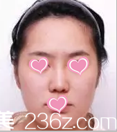 北京美萊注射瘦臉案例術(shù)前照片 北京美萊注射瘦臉案例術(shù)前照片