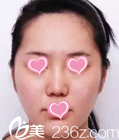 注射瘦臉后第二十三天 注射瘦臉后第二十三天