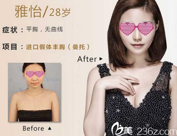 寧波藝星進(jìn)口曼托假體豐胸案例