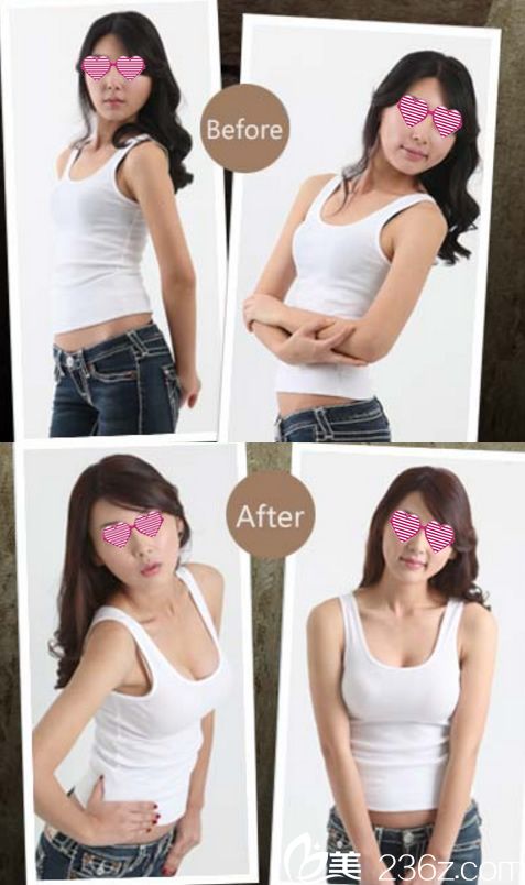 寧波藝星整形醫(yī)院假體隆胸案例