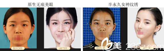 成都藝星雙眼皮+紋眉案例對比 成都藝星雙眼皮+紋眉案例對比