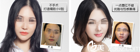 成都藝星瘦臉+半水晶唇案例 成都藝星瘦臉+半水晶唇案例