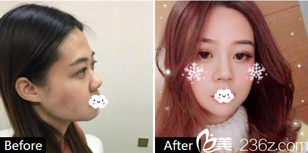 廣州華美整形醫(yī)院易陽(yáng)亮做的皮秒祛斑案例 廣州華美整形醫(yī)院易陽(yáng)亮做的皮秒祛斑案例