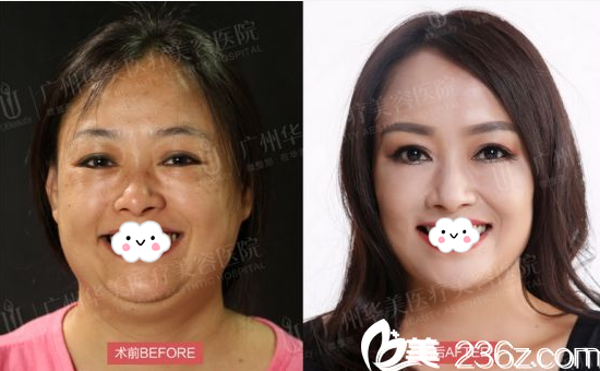 廣州華美整形醫(yī)院易陽(yáng)亮做的激光美白案例 廣州華美整形醫(yī)院易陽(yáng)亮做的激光美白案例