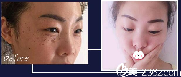 廣州華美整形醫(yī)院易陽(yáng)亮黃褐斑治療案例 廣州華美整形醫(yī)院易陽(yáng)亮黃褐斑治療案例