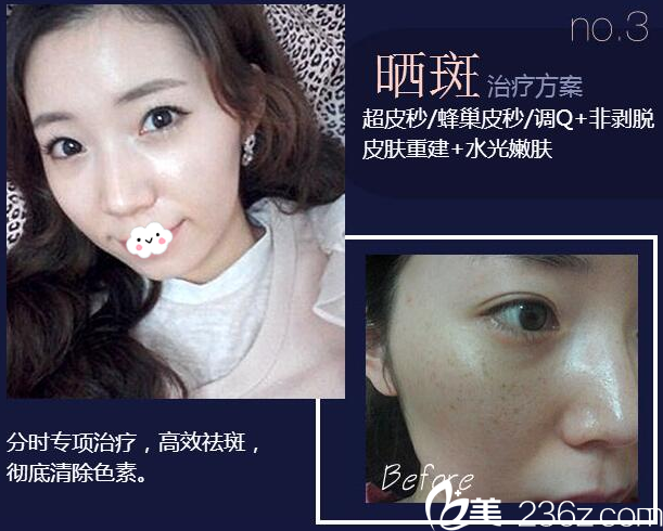 廣州華美整形醫(yī)院易陽(yáng)亮?xí)癜咧委煱咐? alt=