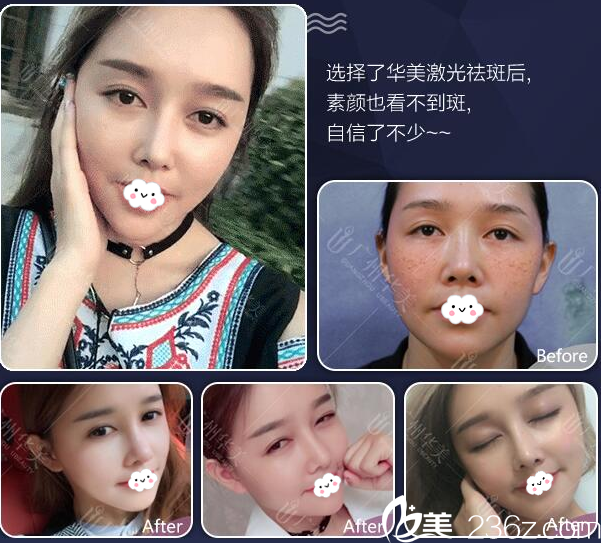 廣州華美整形醫(yī)院易陽(yáng)亮激光祛斑案例 廣州華美整形醫(yī)院易陽(yáng)亮激光祛斑案例