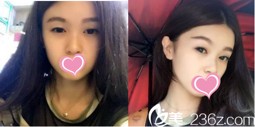 分享我在菏澤華美做雙眼皮的日記 分享我在菏澤華美做雙眼皮的日記