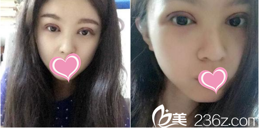 雙眼皮好腫哦 雙眼皮好腫哦