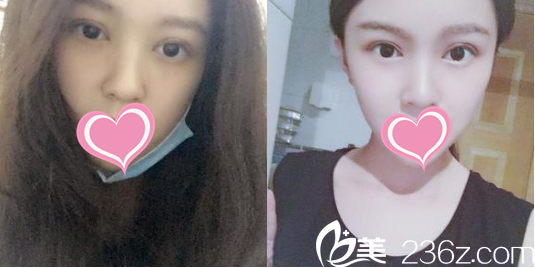 宋方醫(yī)生給我做的雙眼皮樣子 宋方醫(yī)生給我做的雙眼皮樣子