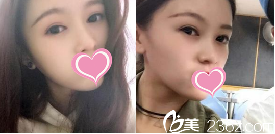 菏澤華美做雙眼皮手術(shù)比較厲害，并且收費(fèi)價(jià)格也能接受