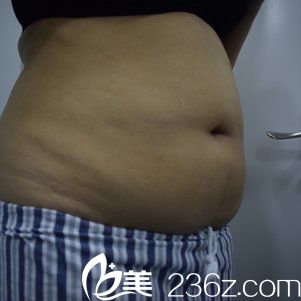 吸脂前腰腹部肥大 吸脂前腰腹部肥大
