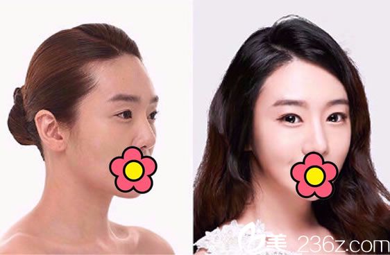 瑞安瑞麗俞劍鋒鼻綜合整形案例 瑞安瑞麗俞劍鋒鼻綜合整形案例