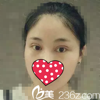 做雙眼皮術(shù)后一周 做雙眼皮術(shù)后一周