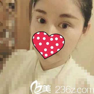 雙眼皮手術(shù)術(shù)后20天效果 雙眼皮手術(shù)術(shù)后20天效果