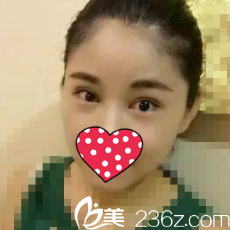 術(shù)后一個(gè)月恢復(fù)情況 術(shù)后一個(gè)月恢復(fù)情況