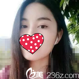 閨蜜看到我找米蘭辰杉王志軍做的雙眼皮恢復后效果，說她也要去