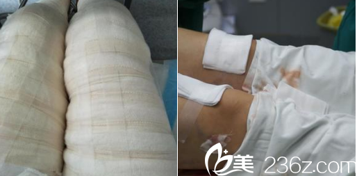 <!--<i data=20240703-sp></i>-->醫(yī)生給我做了吸脂手術(shù)就這樣子了 <!--<i data=20240703-sp></i>-->醫(yī)生給我做了吸脂手術(shù)就這樣子了