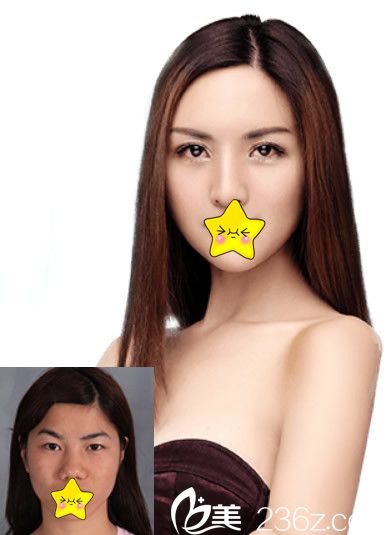 蘭州崔大夫徐生眼鼻整形效果案例 蘭州崔大夫徐生眼鼻整形效果案例