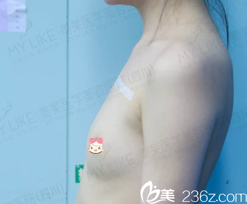 豐胸術(shù)前“一馬平川”的我 豐胸術(shù)前“一馬平川”的我