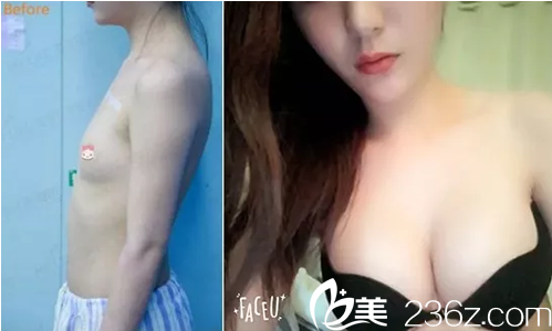 四川美萊吳江山自體脂肪豐胸前后對(duì)比 四川美萊吳江山自體脂肪豐胸前后對(duì)比