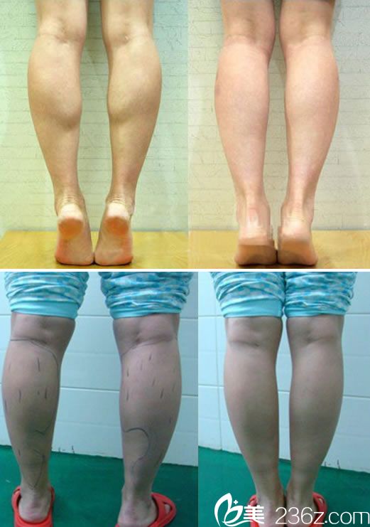 瑞安瑞麗注射瘦臉除皺瘦腿真實案例 瑞安瑞麗注射瘦臉除皺瘦腿真實案例