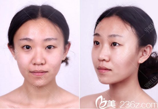 達州雙均醫(yī)院雙眼皮案例術(shù)前照片