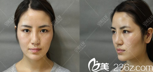 達州雙均醫(yī)院面部輪廓整形術(shù)前照片
