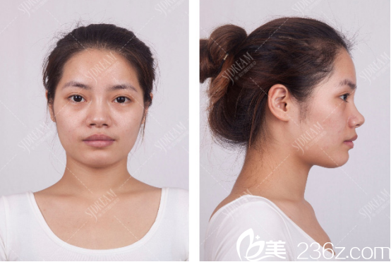 達州雙均醫(yī)院假體隆鼻項目術(shù)前照片