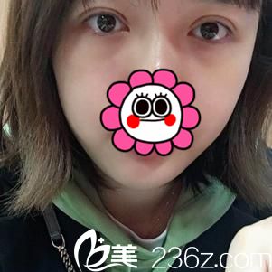 武漢葉子全切雙眼7天恢復(fù)案例圖 好看的不止一點點