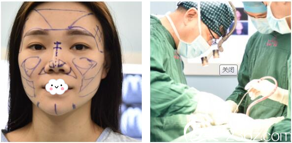 梁曉健院長(zhǎng)隆鼻手術(shù)過(guò)程圖