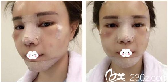 在深圳美萊做隆鼻失敗修復(fù)和脂肪填充2天了