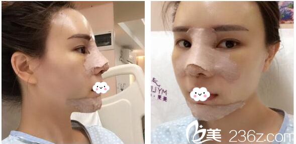 找梁曉健做鼻綜合7天自拍