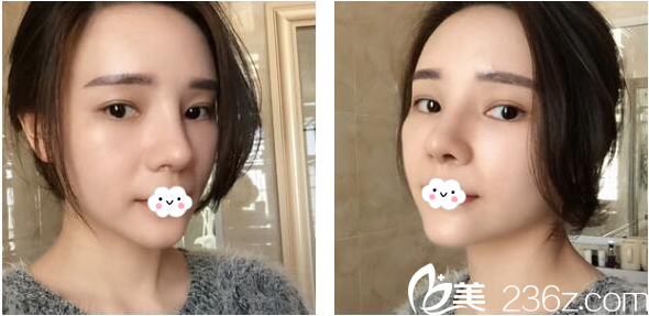 深圳美萊梁曉健隆鼻45天恢復(fù)情況