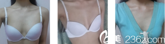 分享我在西安高一生做自體隆胸的日記 分享我在西安高一生做自體隆胸的日記