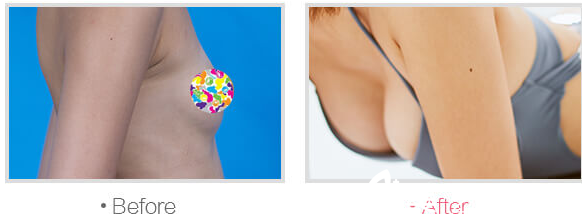 成都米蘭柏羽APC全感豐胸案例 成都米蘭柏羽APC全感豐胸案例