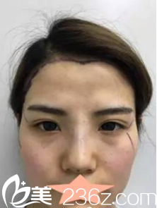 分享我在西安高一生找<!--<i data=20240703-sp></i>-->醫(yī)生做的面部脂肪填充 分享我在西安高一生找<!--<i data=20240703-sp></i>-->醫(yī)生做的面部脂肪填充