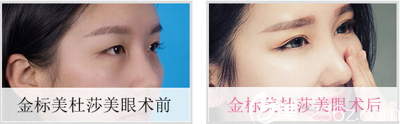 柏羽美杜莎美眼案例對(duì)比 柏羽美杜莎美眼案例對(duì)比