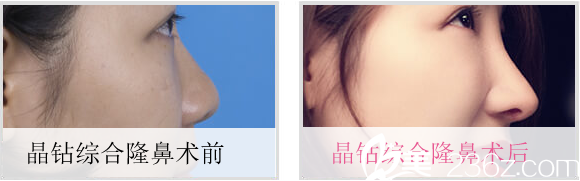 成都米蘭柏羽晶鉆綜合隆鼻術(shù)后對(duì)比照 成都米蘭柏羽晶鉆綜合隆鼻術(shù)后對(duì)比照