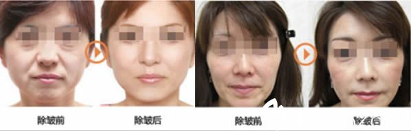 龍巖新羅歐菲全面部除皺前后對比效果 龍巖新羅歐菲全面部除皺前后對比效果