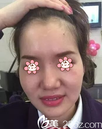 趙弈杉自體脂肪面部填充案例術(shù)前