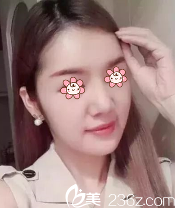 面部填充案例術(shù)后