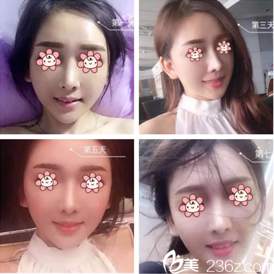 李奕曉紋眉案例 李奕曉紋眉案例