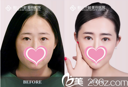 無(wú)痕雙眼皮+開(kāi)眼角真人前后對(duì)比效果 無(wú)痕雙眼皮+開(kāi)眼角真人前后對(duì)比效果